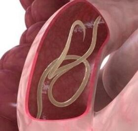 Okrogli črvi so precej pogosti v človeškem črevesju. 